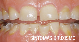 bruxismo