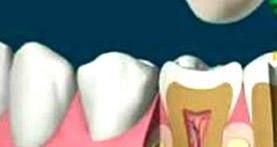 endodoncia