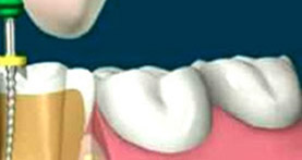 endodoncia