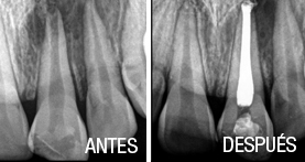 endodoncia