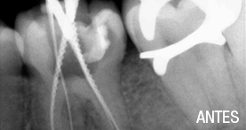endodoncia