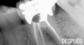 endodoncia