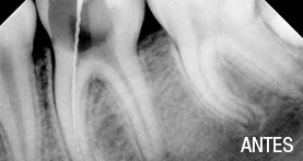 endodoncia