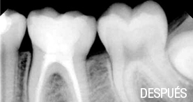 endodoncia