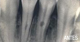 endodoncia