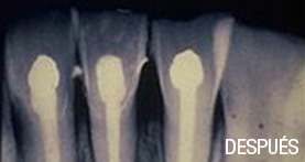 endodoncia
