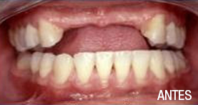 implantes