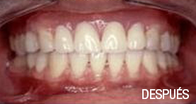 implantes