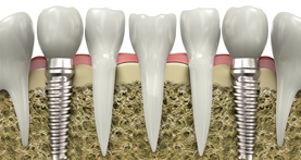 implantes