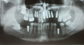 implantes