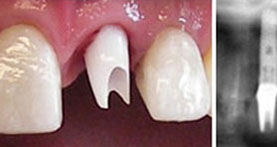 implantes