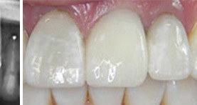 implantes
