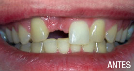 implantes