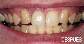 implantes