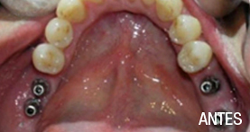 implantes