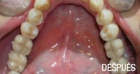 implantes