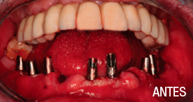 implantes