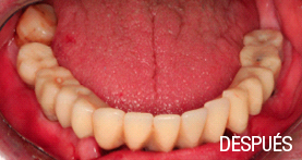 implantes